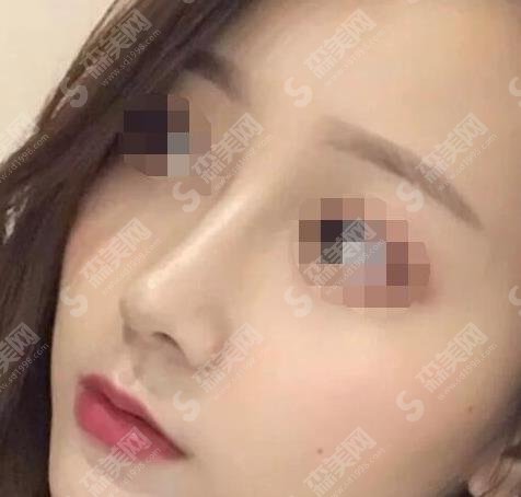 赵延峰做鼻子怎么样?医生口碑如何?案例曝光,快来围观!