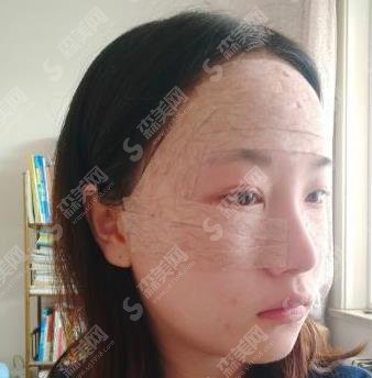 冯斌脂肪填充案例,北京东方冯斌技术如何?案例分享,不看应该后悔!