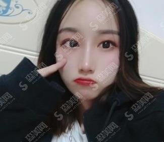 冯斌脂肪填充案例,北京东方冯斌技术如何?案例分享,不看应该后悔!