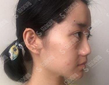 天津医院朱宝骥隆鼻技术好不好?个人简介/案例分享/价格