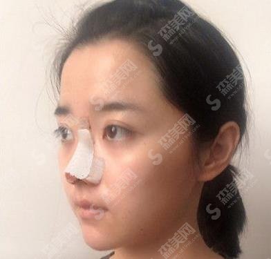 天津医院朱宝骥隆鼻技术好不好?个人简介/案例分享/价格