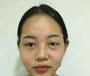 八大处靳小雷全切双眼皮技术如何?医生信息公布及案例分享