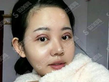 八大处靳小雷全切双眼皮技术如何?医生信息公布及案例分享