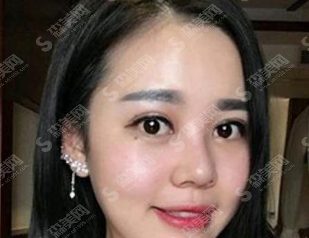 八大处靳小雷全切双眼皮技术如何?医生信息公布及案例分享