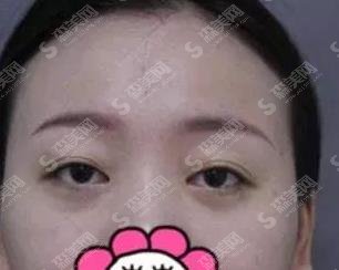 合肥福华赵章杰双眼皮案例,医生简介介绍/案例真实反馈图浏览
