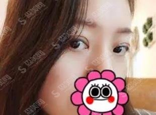 合肥福华赵章杰双眼皮案例,医生简介介绍/案例真实反馈图浏览