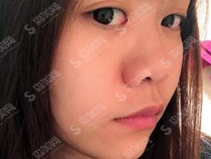 江苏省中医院整形外科黄金龙隆鼻技术如何？案例详情反馈/价格贵不贵/口碑咋样