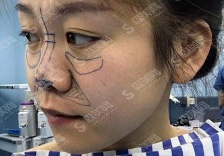 江苏省中医院整形外科黄金龙隆鼻技术如何？案例详情反馈/价格贵不贵/口碑咋样