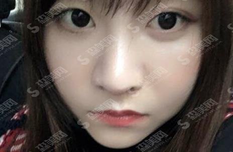 江苏省中医院整形外科黄金龙隆鼻技术如何？案例详情反馈/价格贵不贵/口碑咋样