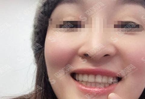 大庆固尔口腔牙齿矫正技术怎么样？案例术后果变女神&内含矫正价格表