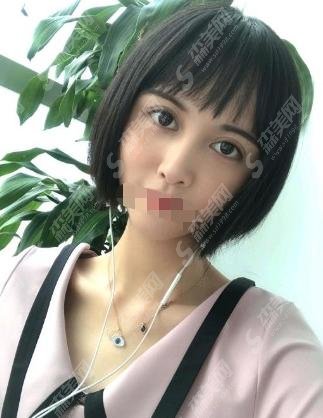 做双眼皮手术哪家好？邯郸三院实力推荐！赶快来认识下~