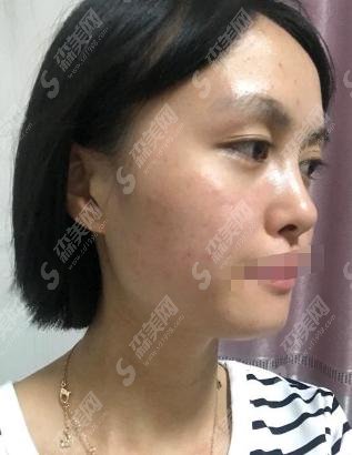 做双眼皮手术哪家好？邯郸三院实力推荐！赶快来认识下~