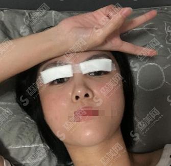 做双眼皮手术哪家好？邯郸三院实力推荐！赶快来认识下~
