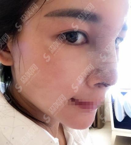 沈阳杏林整形医院隆鼻技术好吗?医院介绍加案例分享为您揭晓答案