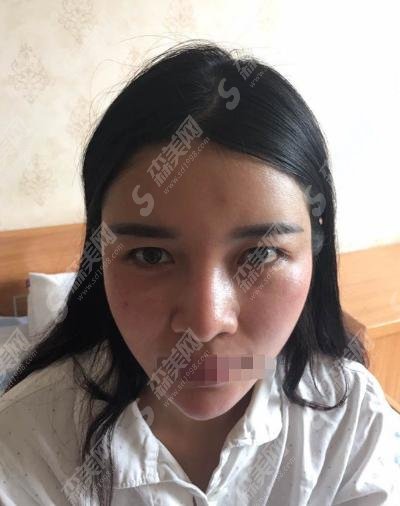 沈阳杏林整形医院隆鼻技术好吗?医院介绍加案例分享为您揭晓答案