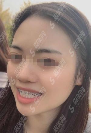 黄石市中心医院有口腔科么？牙齿矫正案例分享+2021价格表