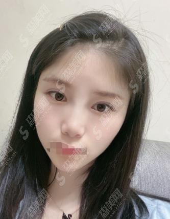 上海九院和星璨医院哪家医生的技术好?九院做的双眼皮果很美!