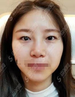 上海九院和星璨医院哪家医生的技术好?九院做的双眼皮果很美!