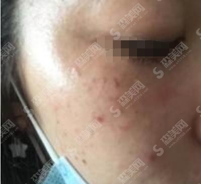 费县美容医院做光子嫩肤哪家强?山东费县人民医院位居第一!