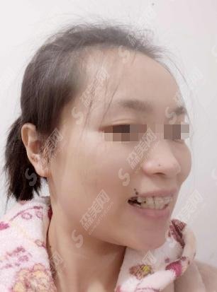 广大口腔医院崔巧明医生技术如何？来看做的牙齿矫正恢复果！附价格表分享