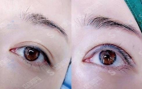 武汉双眼皮修复医生排名前十名单，武汉整形医生汇总，2021实力PK