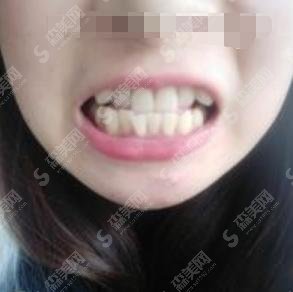 三门峡牙科诊所哪个好的？中心医院口腔科榜上有名！附美白牙齿案例