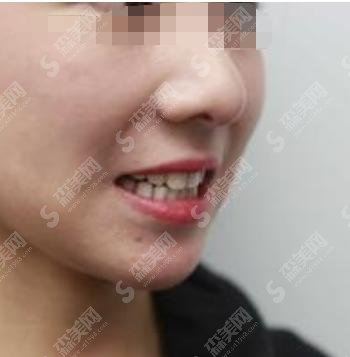 西京医院口腔医院专家技术厉害，牙齿美白案例完美呈现！