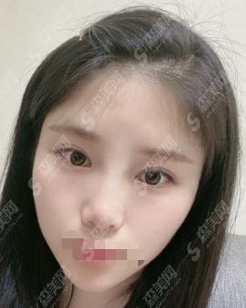 西安交通大学第一附属医院整形科做的双眼皮怎样?又大又有气质!都说医院没有来后悔!