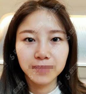 西安交通大学第一附属医院整形科做的双眼皮怎样?又大又有气质!都说医院没有来后悔!