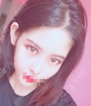 广西玉林华美整形医院医生曝光!医院做的隆鼻手术好评不断!