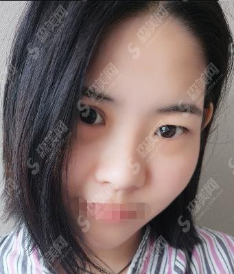 广西玉林华美整形医院医生曝光!医院做的隆鼻手术好评不断!