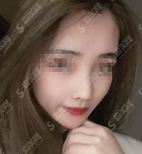 李战强做鼻子怎么样?真实案例大揭秘！