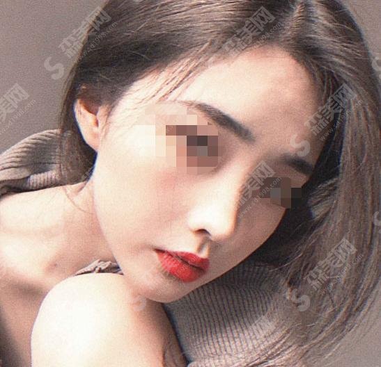 李战强做鼻子怎么样?真实案例大揭秘！