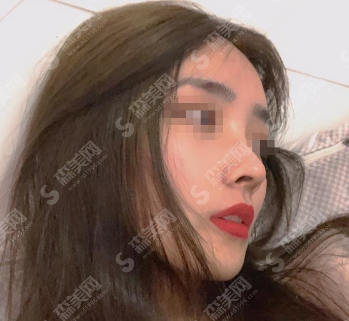 李战强做鼻子怎么样?真实案例大揭秘！