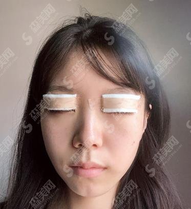 杨丽双眼皮做的可以吗?热乎的个人简介来咯~其所在的郑大二院整形外科口碑可以吗?