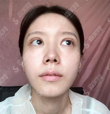 杨丽双眼皮做的可以吗?热乎的个人简介来咯~其所在的郑大二院整形外科口碑可以吗?