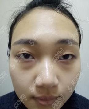 郑东美眼张行双眼皮修复技术怎么样?医生信息公布/眼部整形案例分享