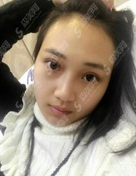 郑东美眼张行双眼皮修复技术怎么样?医生信息公布/眼部整形案例分享