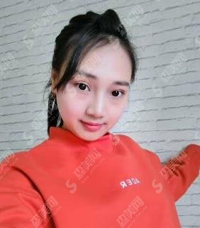 郑东美眼张行双眼皮修复技术怎么样?医生信息公布/眼部整形案例分享