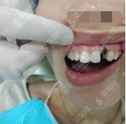 北大口腔医院价格明细如何？牙齿种植果对比值得青睐！