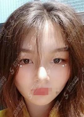 九院的韦敏医生做的双眼皮如何？术前术后案例果！附双眼皮较新价格表