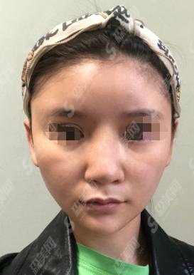齐鲁医院整形科赵琦医师怎么样？赵琦医师做的隆鼻果如何？附齐鲁医院隆鼻较新价格！