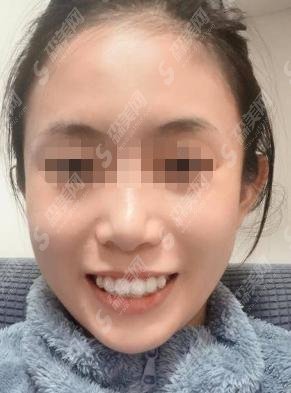 兰州皓亚口腔医院做的牙齿矫正前后对比！刘淑梅医师技术怎么样？附2021较新口腔价格表