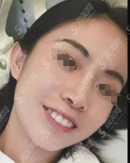 兰州皓亚口腔医院做的牙齿矫正前后对比！刘淑梅医师技术怎么样？附2021较新口腔价格表