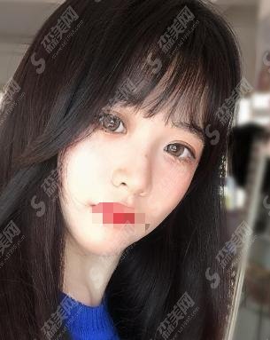 商丘华美整形医院李云霞口碑怎么样?医师做的双眼皮果曝光!内含该院较新双眼皮价格一览