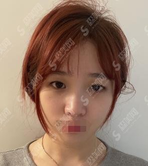 商丘华美整形医院李云霞口碑怎么样?医师做的双眼皮果曝光!内含该院较新双眼皮价格一览