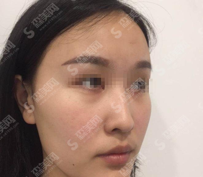 深圳三甲整容医院有哪些做鼻子不错?北大深圳榜上有名,果完美价格惠民!