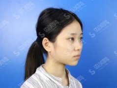 漯河市中心医院整形科价目表来了，鼻部手术术后果图浏览