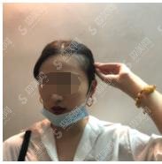 广州正规的植发三甲医院做发际线植发果很棒！南方医科大医院榜上有名！