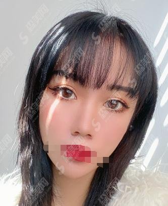 上海九院割双眼皮较好的医生是谁？金云波医师做的双眼皮好么？附案例一看及价格表